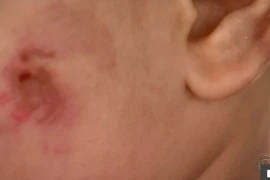 Bé 17 tháng kín vết cắn trên người, lời giải thích của cô giáo càng "dậy sóng"