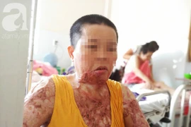 Người phụ nữ bị tình cũ tạt axit bỏng nặng khi níu kéo