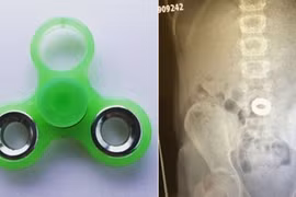 Bé gái suýt tắc thở vì trò chơi spinner đang khuấy đảo trẻ em