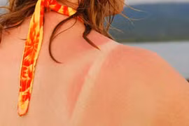 Điều gì xảy ra với cơ thể khi làn da bị cháy nắng