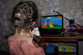 Học theo trò chơi làm nàng tiên, bé gái bỏng toàn thân