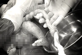 Cứu sống thai nhi có nút thắt dây rốn hiếm gặp 
