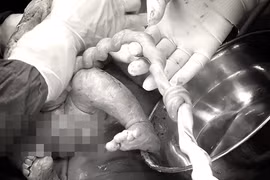 Cứu sống thai nhi có nút thắt dây rốn hiếm gặp 