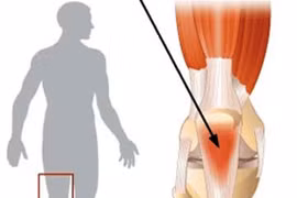 Triệu chứng của viêm gân bánh chè