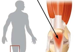 Triệu chứng của viêm gân bánh chè