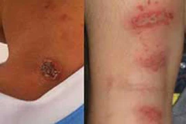 Phân biệt viêm da và nhiễm ký sinh trùng