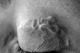 Nhiễm ấu trùng giun đũa chó thể nội tạng