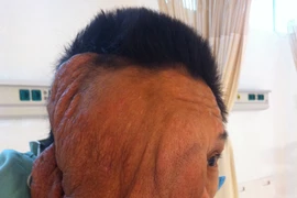 Phẫu thuật thành công khối u xơ thần kinh khổng lồ