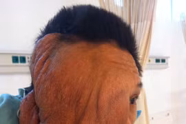 Phẫu thuật thành công khối u xơ thần kinh khổng lồ