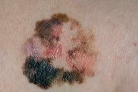 Bướu ác “hắc tố” ở da