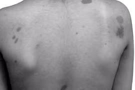 U sợi thần kinh là bệnh gì?