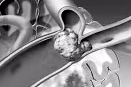 Huyết khối ở tim gây đột quỵ não