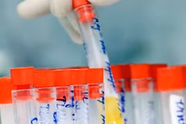 Xét nghiệm dương tính bệnh nhiễm khi mang thai