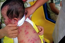 Bênh sởi lành tính thế sao trẻ nhỏ phải chết?
