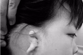 Điều trị cho trẻ sinh ra không có tai