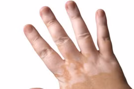 Bệnh lang trắng dễ nhầm ung thư