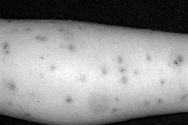 Sẩn ngứa cục do bọ chét