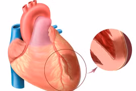 Kẹt van do máu cục vì không dùng thuốc chống đông