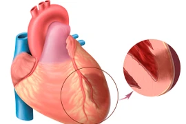 Kẹt van do máu cục vì không dùng thuốc chống đông