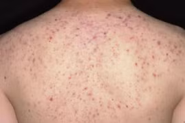 Trị mụn tại spa, bệnh nhân bị rối loạn nhịp tim vì thuốc tê