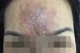 Bệnh viện Mắt TP HCM cấp cứu nhiều ca tổn thương mắt do làm đẹp ở cơ sở chui