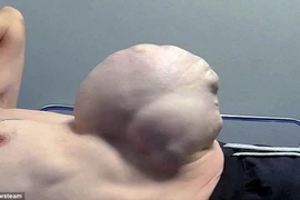 Kinh ngạc người đàn ông khi ho bụng bự như trái bóng