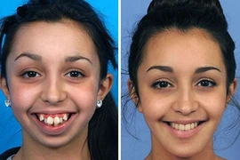 9X “vịt hóa thiên nga” nhờ dao kéo tự tin thi hoa hậu