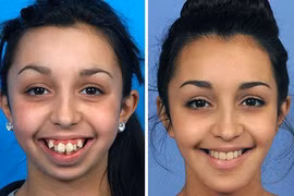 9X “vịt hóa thiên nga” nhờ dao kéo tự tin thi hoa hậu