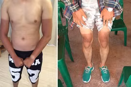 Dân mạng khoe ảnh da cháy nắng, “phát điên” vì nắng nóng