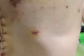 Bé gái 3 tuổi bị chó cắn thủng bụng, chấn thương nặng 