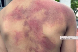 Bé trai 5 tuổi chi chít vết thương khắp người do cha ruột bạo hành