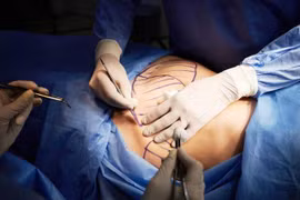 Bị hôn mê, mất 6 lít máu sau khi hút mỡ ở thẩm mỹ viện 