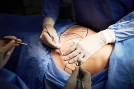 Bị hôn mê, mất 6 lít máu sau khi hút mỡ ở thẩm mỹ viện 