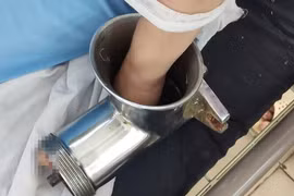 Người phụ nữ ở miền Tây bị máy xay thịt nghiền nát bàn tay