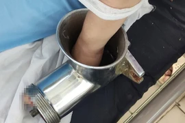 Người phụ nữ ở miền Tây bị máy xay thịt nghiền nát bàn tay