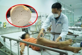  3 bệnh nhân ngộ độc giò lụa bị liệt hoàn toàn do không có thuốc giải độc 