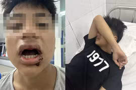 Nam sinh bị côn đồ đánh gãy 4 cái răng, nhận nước khi đi tắm biển