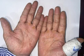 Mắc ung thư biểu mô tế bào vảy vì dùng thạch tín điều trị hen