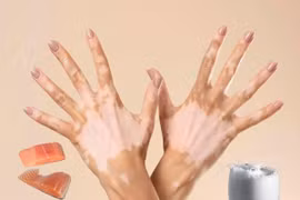 Uống sữa sau khi ăn cá không phải nguyên nhân gây bệnh bạch biến