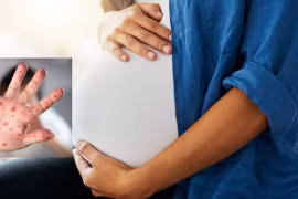 Bệnh tay chân miệng có gây rủi ro cho thai kỳ?