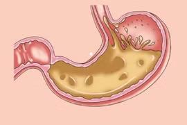 5 điều cực đơn giản giúp tránh xa bệnh trào ngược dạ dày