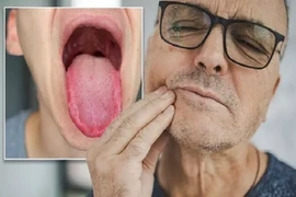 Những dấu hiệu ở lưỡi cảnh báo mắc ung thư 