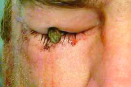 Bị cây đinh dài 7cm đâm vào mắt vẫn nhìn bình thường