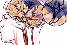 Đời sống cao càng có nhiều người thiếu máu não