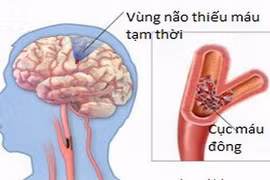 Kết hợp Đông, Tây y điều trị thiểu năng tuần hoàn não 
