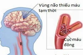 Kết hợp Đông, Tây y điều trị thiểu năng tuần hoàn não 