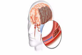 Các yếu tố nguy cơ dẫn đến thiếu máu não 