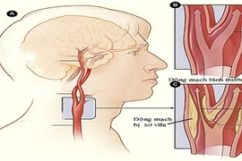 Cách giảm biến chứng thiểu năng tuần hoàn não