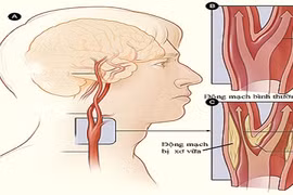 Cách giảm biến chứng thiểu năng tuần hoàn não