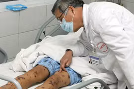 27 người bị cách ly sau ca viêm não mô cầu tại HN